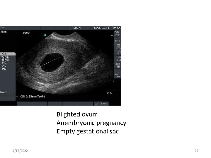 Blighted ovum Anembryonic pregnancy Empty gestational sac 1/12/2022 24 