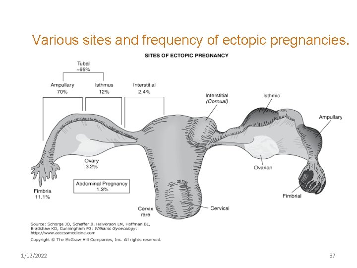 Various sites and frequency of ectopic pregnancies. 1/12/2022 37 
