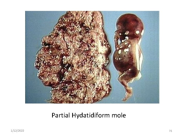 Partial Hydatidiform mole 1/12/2022 76 