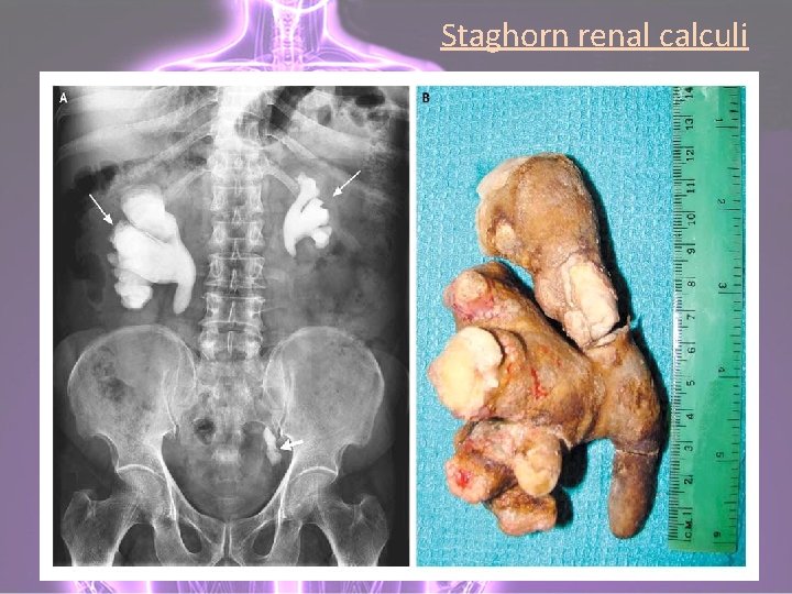 Staghorn renal calculi 
