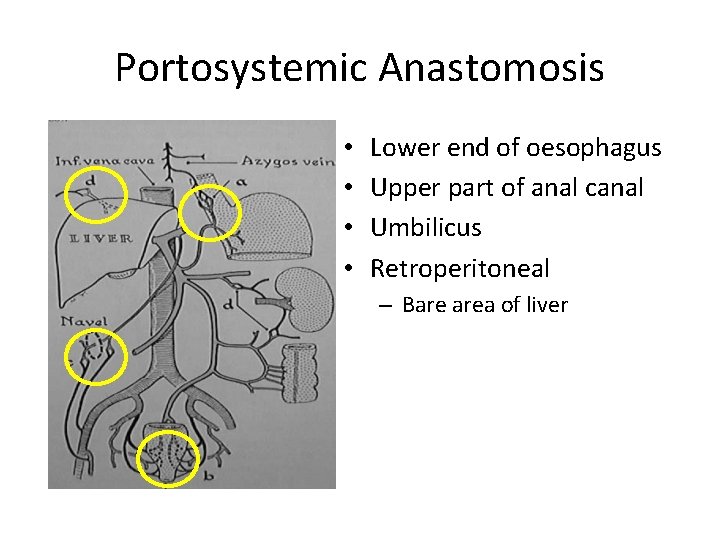 Portosystemic Anastomosis • • Lower end of oesophagus Upper part of anal canal Umbilicus
