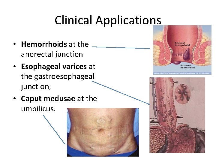 Clinical Applications • Hemorrhoids at the anorectal junction • Esophageal varices at the gastroesophageal
