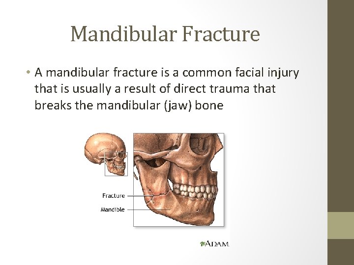Mandibular Fracture • A mandibular fracture is a common facial injury that is usually