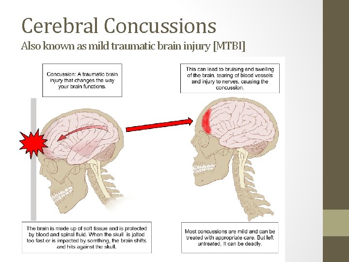Cerebral Concussions Also known as mild traumatic brain injury [MTBI] 