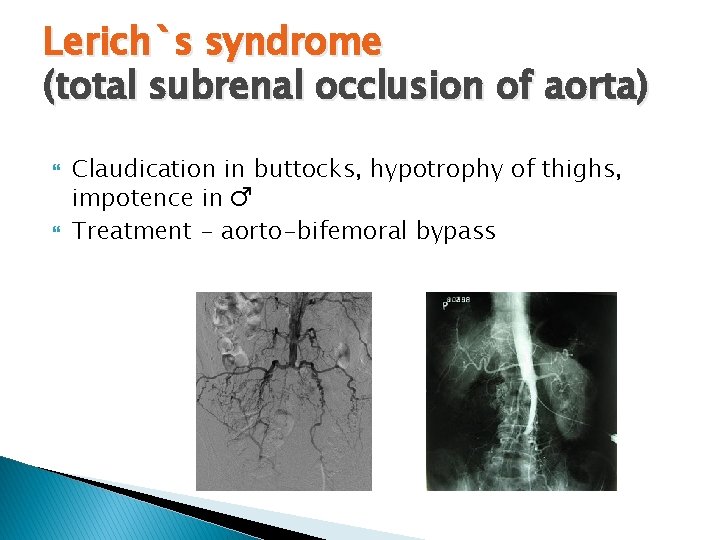 Lerich`s syndrome (total subrenal occlusion of aorta) Claudication in buttocks, hypotrophy of thighs, impotence