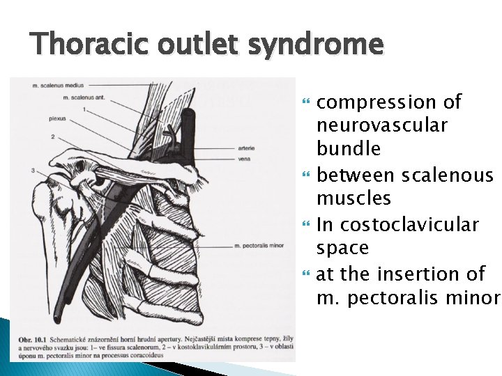 Thoracic outlet syndrome compression of neurovascular bundle between scalenous muscles In costoclavicular space at
