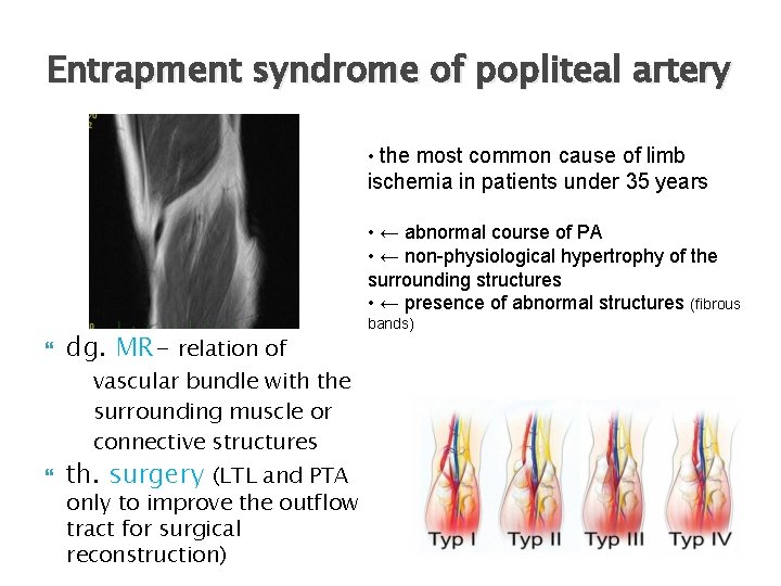 Entrapment syndrome of popliteal artery • the most common cause of limb ischemia in