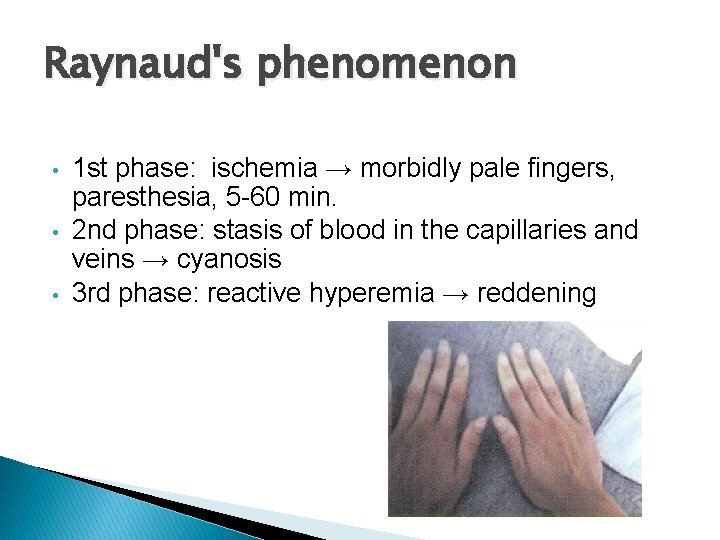 Raynaud's phenomenon • • • 1 st phase: ischemia → morbidly pale fingers, paresthesia,