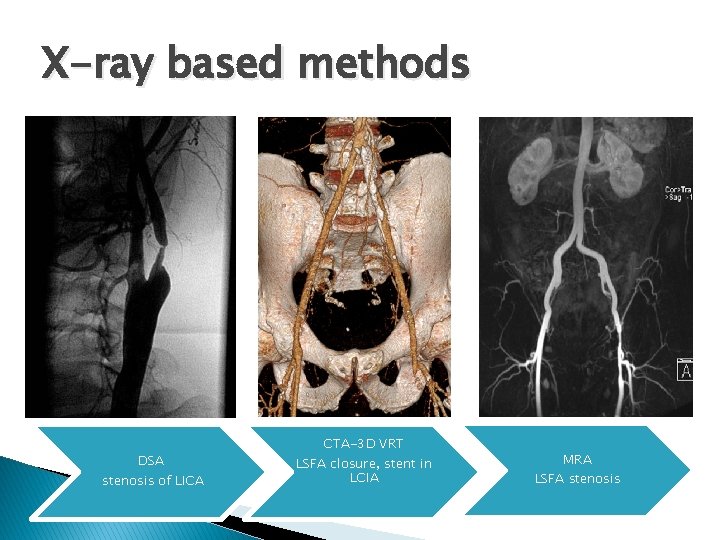 X-ray based methods DSA stenosis of LICA CTA-3 D VRT LSFA closure, stent in