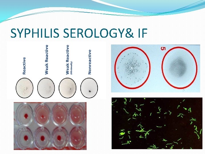 SYPHILIS SEROLOGY& IF 