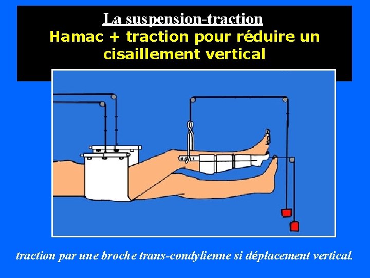 La suspension-traction Hamac + traction pour réduire un cisaillement vertical traction par une broche