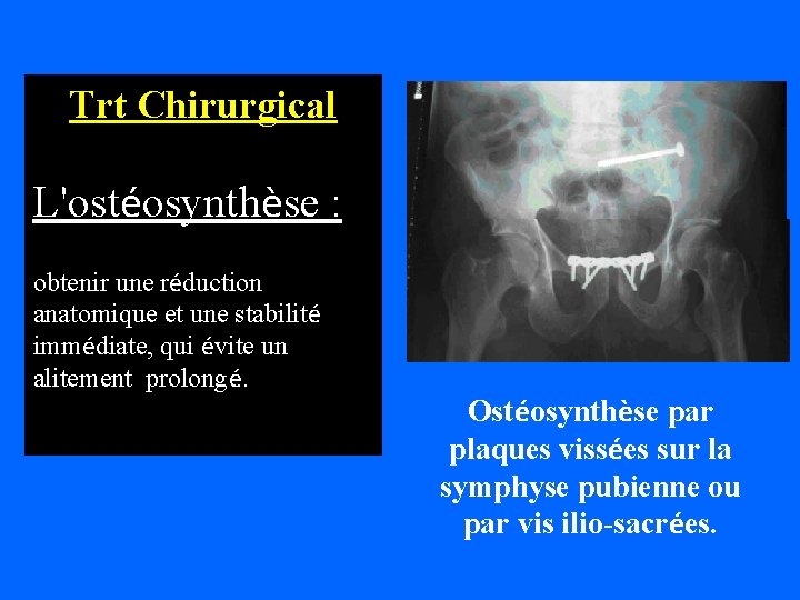 Trt Chirurgical L'ostéosynthèse : obtenir une réduction anatomique et une stabilité immédiate, qui évite