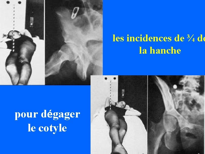 les incidences de ¾ de la hanche pour dégager le cotyle 