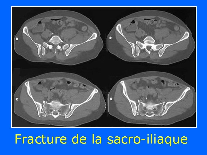 Fracture de la sacro-iliaque 