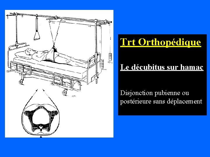 Trt Orthopédique Le décubitus sur hamac Disjonction pubienne ou postérieure sans déplacement 