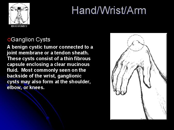 Hand/Wrist/Arm ERGONOMICS ¢Ganglion Cysts A benign cystic tumor connected to a joint membrane or