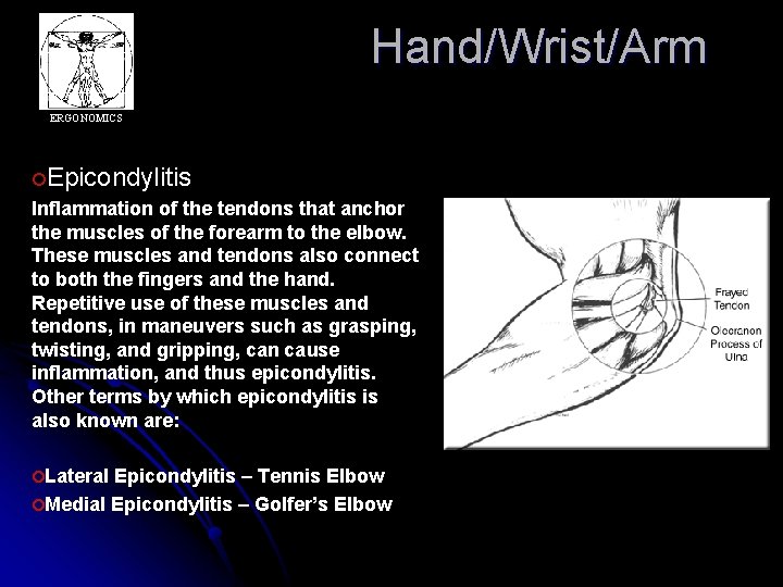 Hand/Wrist/Arm ERGONOMICS ¢Epicondylitis Inflammation of the tendons that anchor the muscles of the forearm