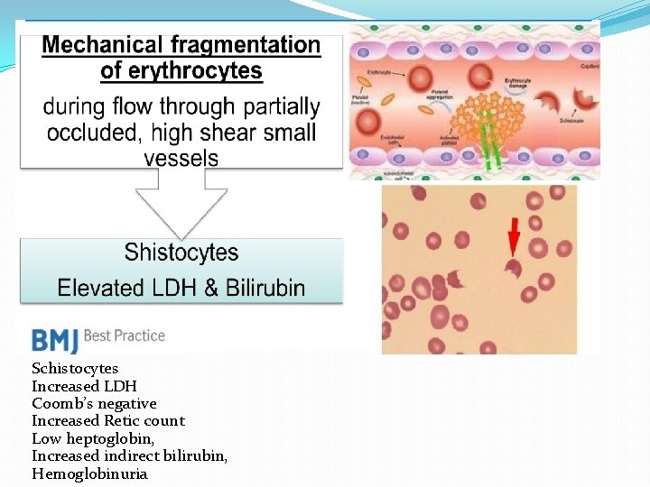 Schistocytes Increased LDH Coomb’s negative Increased Retic count Low heptoglobin, Increased indirect bilirubin, Hemoglobinuria