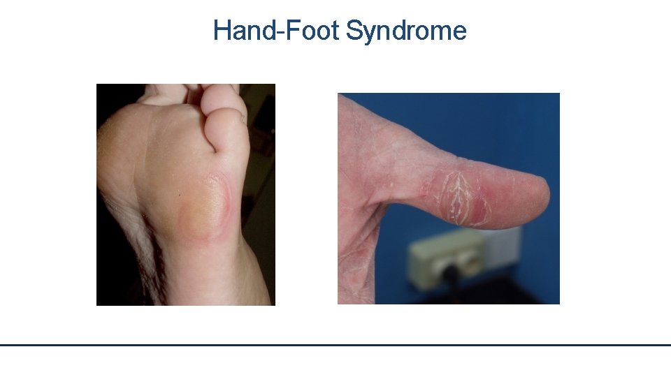 Hand-Foot Syndrome 