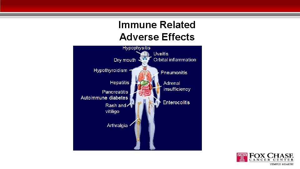Immune Related Adverse Effects 