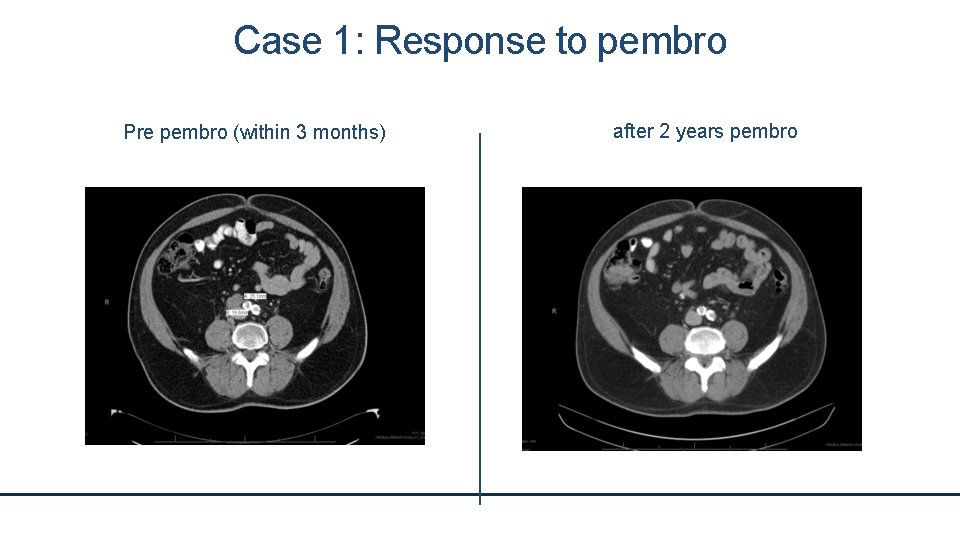 Case 1: Response to pembro Pre pembro (within 3 months) after 2 years pembro