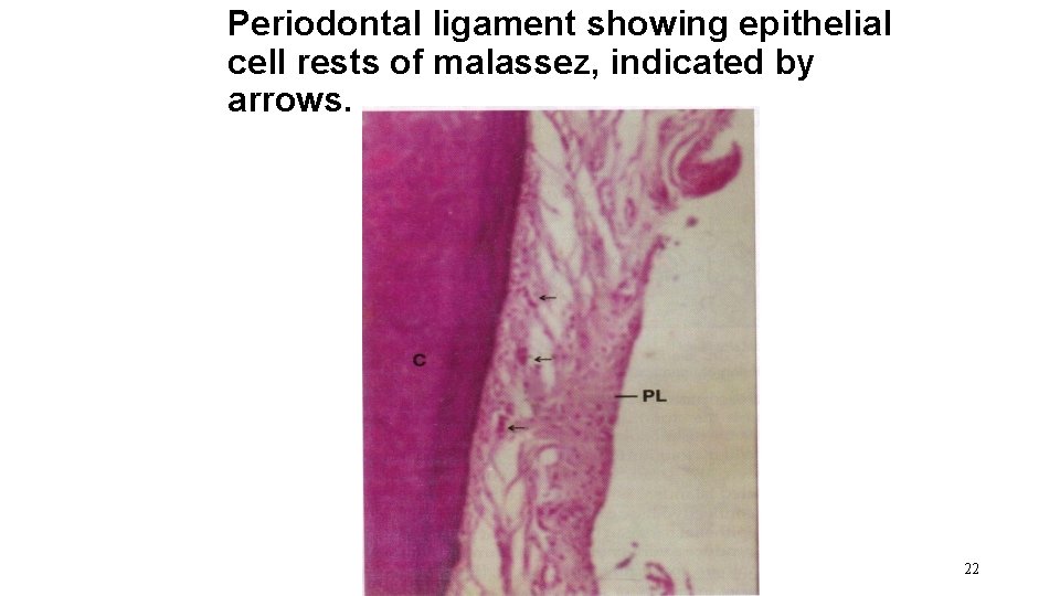 Periodontal ligament showing epithelial cell rests of malassez, indicated by arrows. 22 