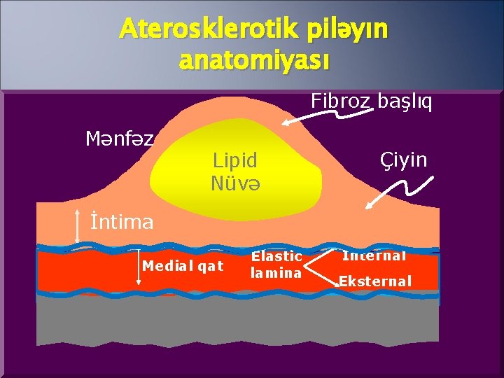 Aterosklerotik piləyın anatomiyası Fibroz başlıq Mənfəz Lipid Nüvə Çiyin İntima Medial qat Elastic lamina