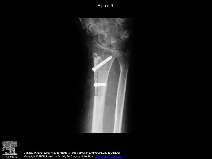 Vascularized Distal Radius Bone Graft for Treatment of