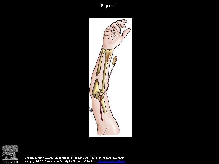 Figure 1 Journal of Hand Surgery 2018 43685. e 1 -685. e 5 DOI: