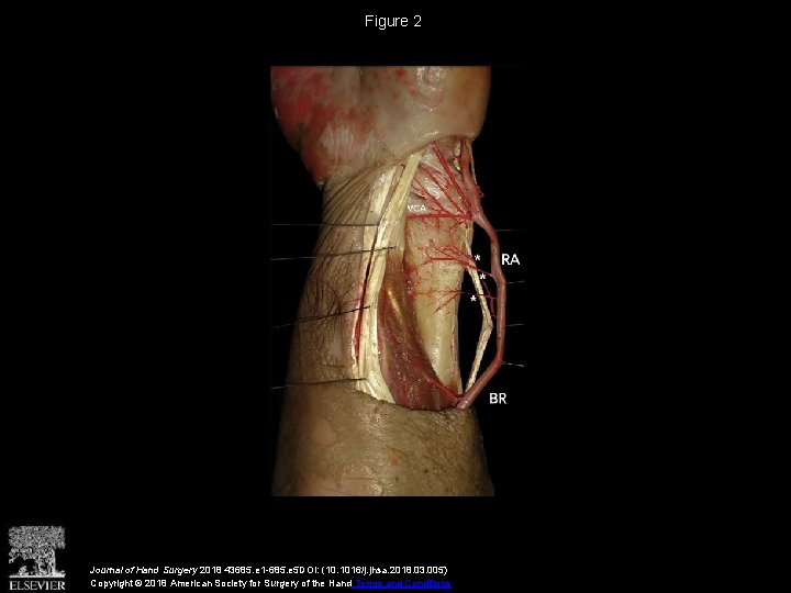 Figure 2 Journal of Hand Surgery 2018 43685. e 1 -685. e 5 DOI: