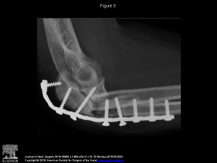 Vascularized Distal Radius Bone Graft for Treatment of