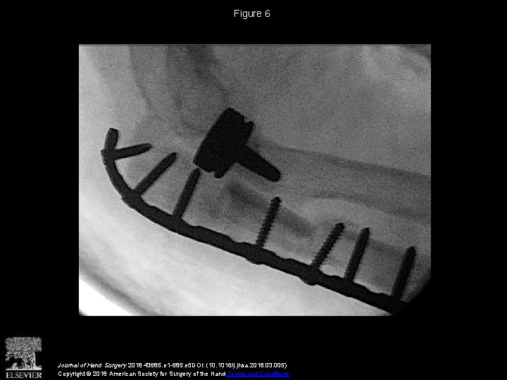 Figure 6 Journal of Hand Surgery 2018 43685. e 1 -685. e 5 DOI: