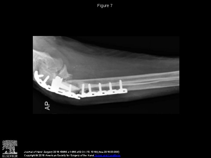 Figure 7 Journal of Hand Surgery 2018 43685. e 1 -685. e 5 DOI: