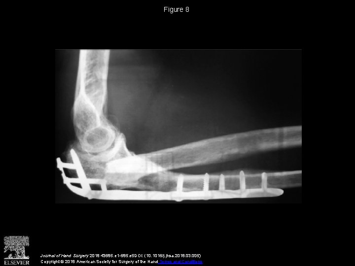 Figure 8 Journal of Hand Surgery 2018 43685. e 1 -685. e 5 DOI: