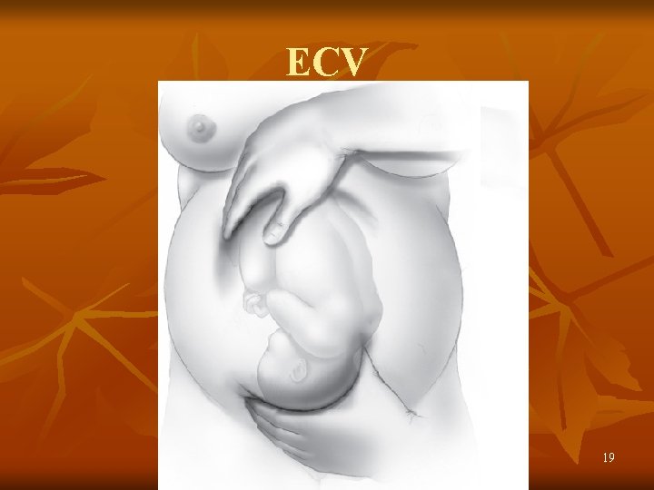 ECV 19 