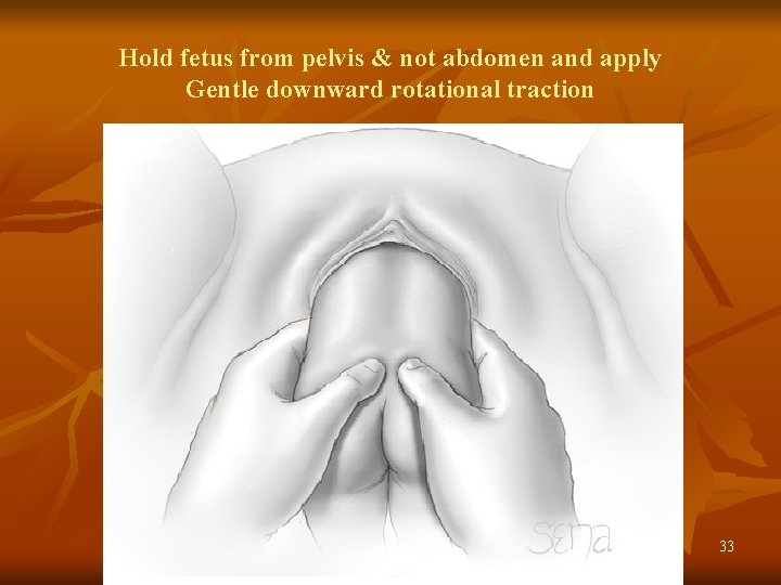 Hold fetus from pelvis & not abdomen and apply Gentle downward rotational traction 33