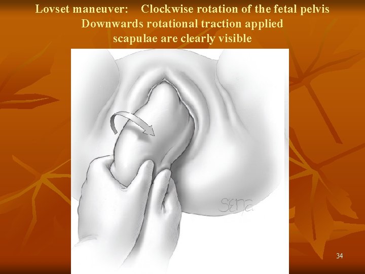 Lovset maneuver: Clockwise rotation of the fetal pelvis Downwards rotational traction applied scapulae are