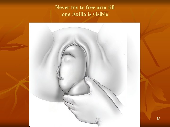 Never try to free arm till one Axilla is visible 35 