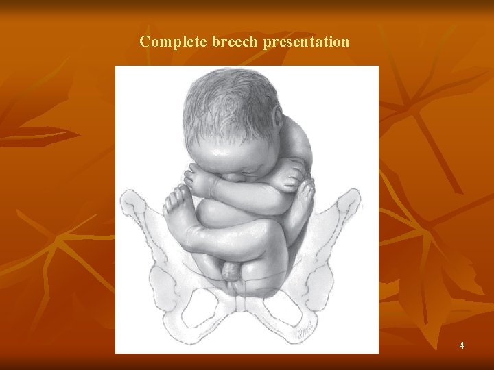 Complete breech presentation 4 