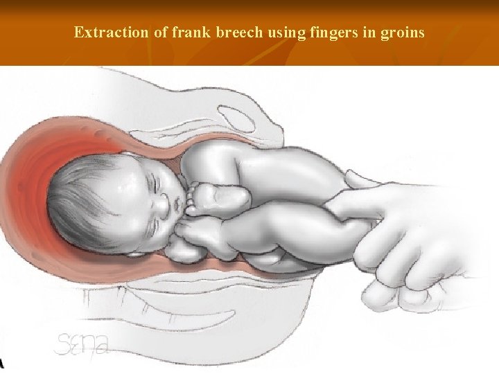 Extraction of frank breech using fingers in groins 40 