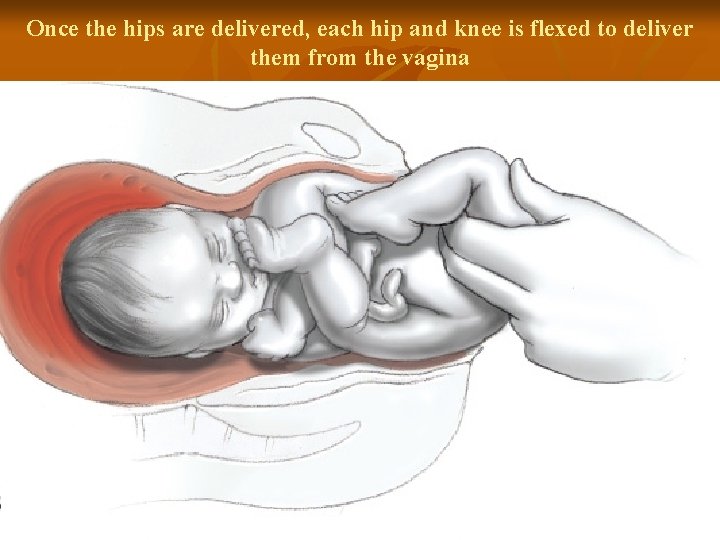 Once the hips are delivered, each hip and knee is flexed to deliver them