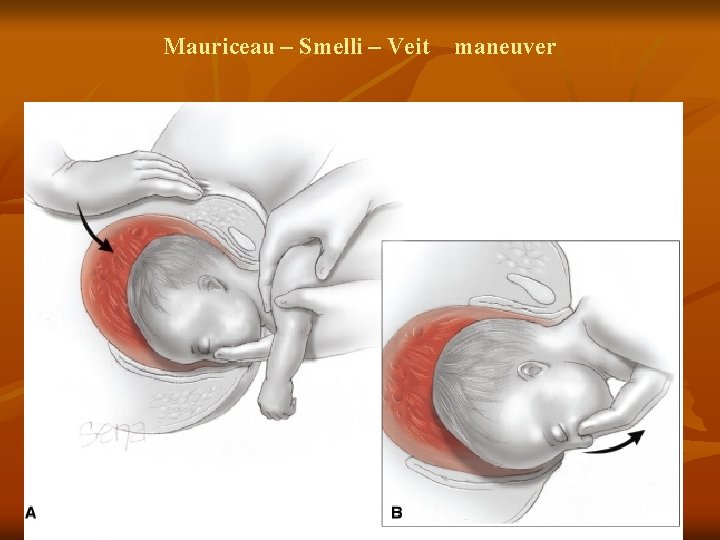 Mauriceau – Smelli – Veit maneuver 45 