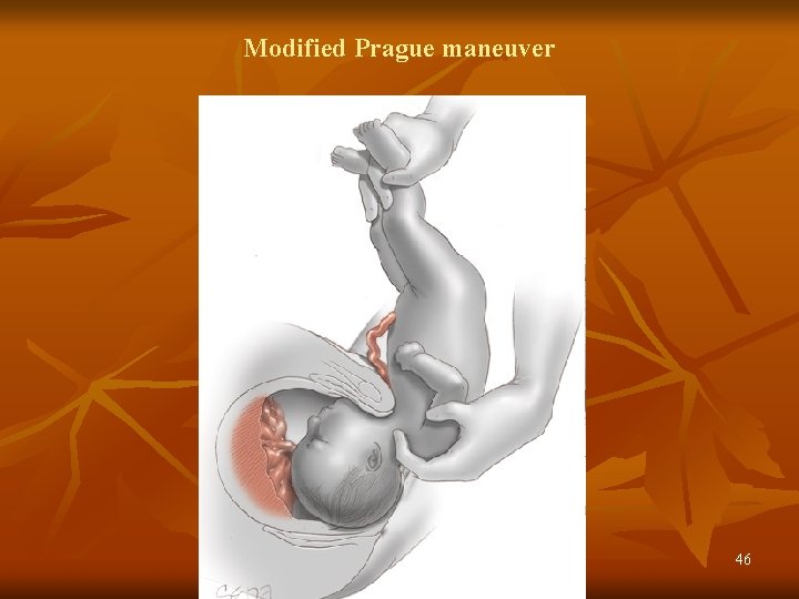 Modified Prague maneuver 46 