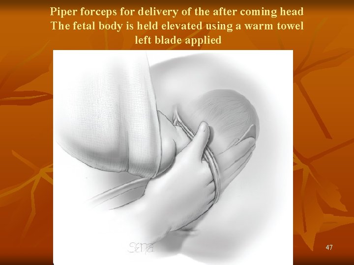 Piper forceps for delivery of the after coming head The fetal body is held