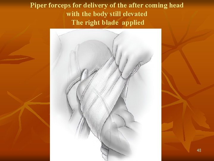 Piper forceps for delivery of the after coming head with the body still elevated