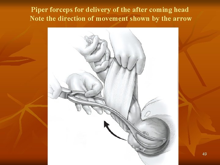 Piper forceps for delivery of the after coming head Note the direction of movement