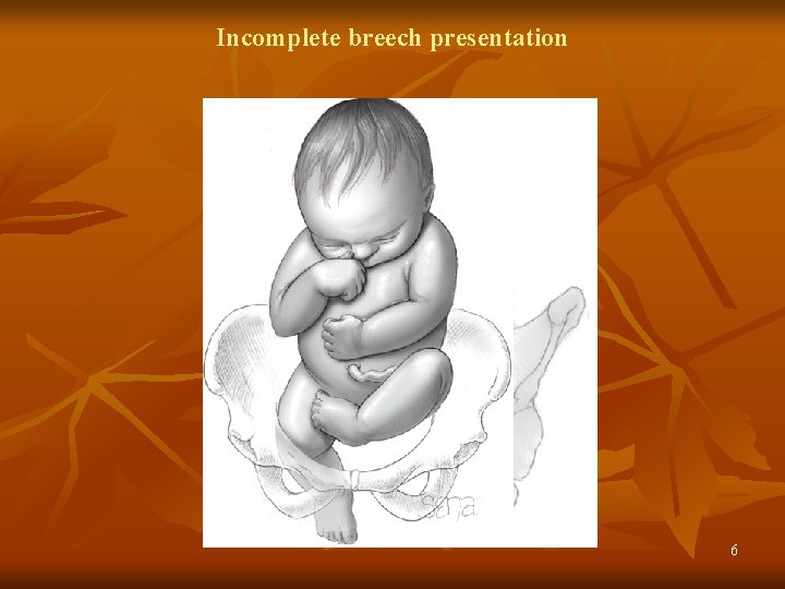 Incomplete breech presentation 6 