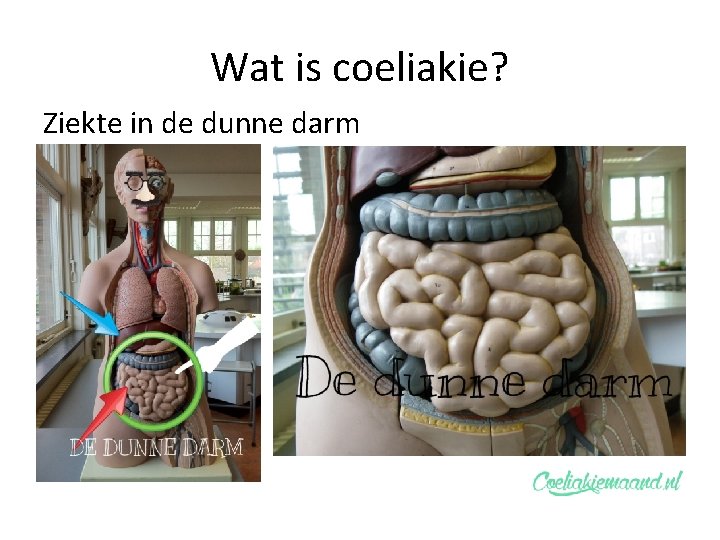 Wat is coeliakie? Ziekte in de dunne darm 