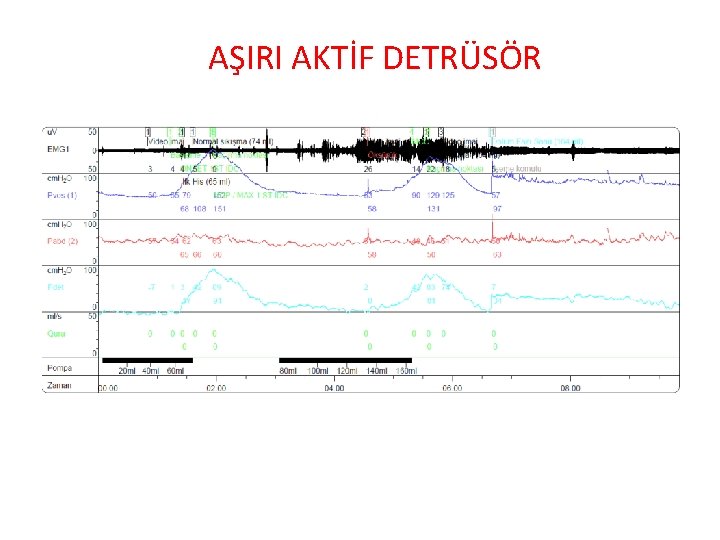 AŞIRI AKTİF DETRÜSÖR 