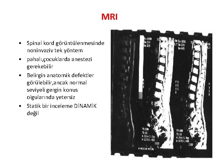 MRI • Spinal kord görüntülenmesinde noninvaziv tek yöntem • pahalı, çocuklarda anestezi gerekebilir •